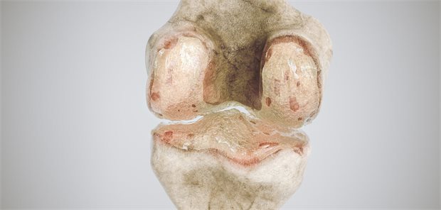 Kaputte Knie? Schlecht für die Blutzuckerkontrolle! Bild einer Kniegelenksarthrose