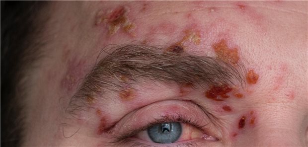 Herpes zoster am Auge bei Immungesunden kein Hinweis auf erhöhtes Krebsrisiko Ausschnitt des Gesicht eines Mannes mit vielen Bläschen eines zoster ophthalmicus um das Auge und auf der Stirn.