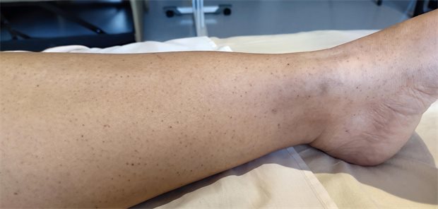 Bei diesen Hautbefunden auch an Hantavirus denken Petechien, also kleine Einblutungen in die Haut, an einem Bein.