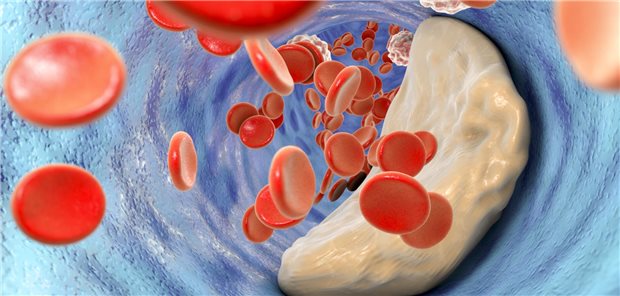 Schützt Vitamin-K-Supplementierung vor Koronarverkalkung? Plaque im Blutgefäß