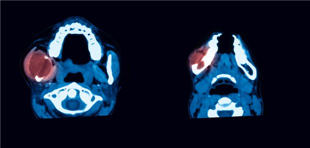 Rezidivierende Tumorbildung im linken Unterkiefer Bilder einer Computertomographie des Kopfes mit einem durch Markierung in rot hervorgehobenen Tumor im linken Unterkiefer.