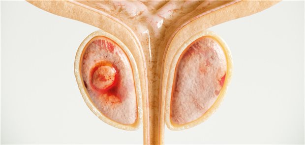 Prostatakrebs: Die Deutsche Gesellschaft für Urologie fordert, ein PCa-Früherkennungsprogramm in Deutschland als GKV-Leistung zu verankern.