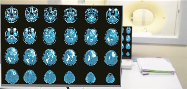 Metaanalyse: PPI könnten Prognose von Patienten mit Hirntumoren verschlechtern Protonenpumpeninhibitoren könnten die Prognose von Patienten mit Glioblastomen verschlechtern. Schweizer Forschende sprechen sich dafür aus, die Substanzen hier nicht einzusetzen.