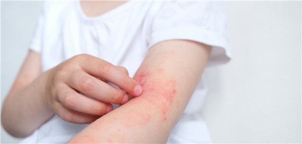 Atopische Dermatitis belastet viele Kinder seelisch sehr Nahaufnahme eines Kind mit atopischer Dermatitis, dass sich an der atopischen Haut in seiner Armebeuge kratzt.
