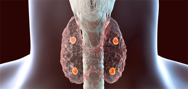 Übertherapie mit Schilddrüsenhormon L-Thyroxin hält an Schilddrüse