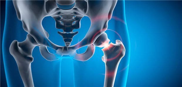 Nach der Hüft-Operation: Sind Schmerzen eine Gefahr für das Herz? Dreidimensionale medizinische Illustration einer Fraktur des linken Hüftgelenks.