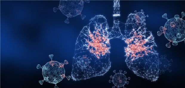 Variables Immundefektsyndrom: Viele Infekte sollten aufhorchen lassen Schwere Pneumonien können auf ein variables Immundefektsyndrom hindeuten.
