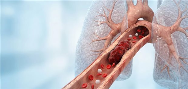 Akute Lungenembolie: Was die optimale Therapie ausmacht Blutgefäß mit Thrombose.