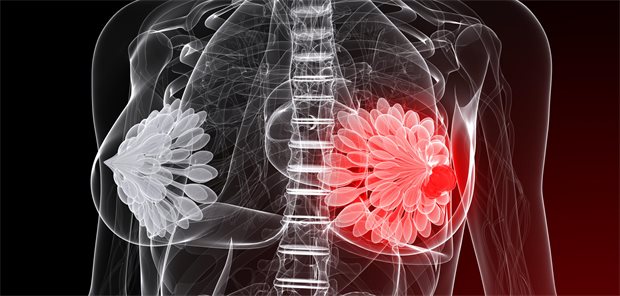 Studie: Geringere Brustkrebssterblichkeit mit Statin-Therapie Illustration von Krebs in der linken Brust.