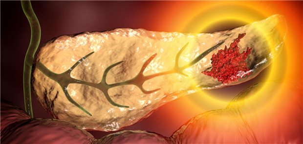 Daraxonrasib beim Pankreaskarzinom: Besser als die Chemotherapie? Abbildung des Pankreas mit Karzinom