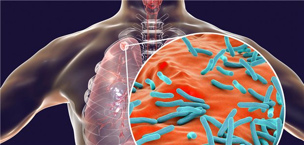 Tuberkulose-Erreger in schematischer Darstellung