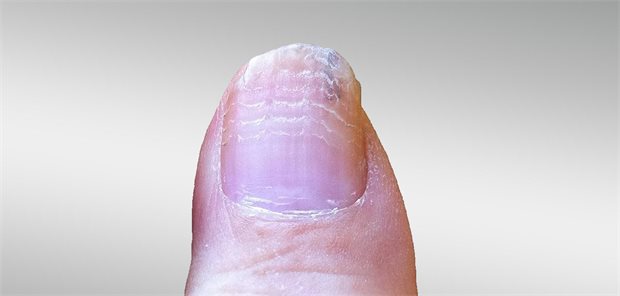 Nagelveränderungen geben Hinweis auf Chemotherapiezyklen Foto eines Nagels mit weissen Querrillen.