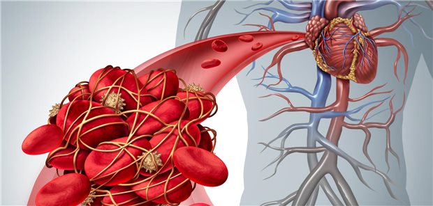 So geht die Plättchenhemmer-Therapie in der Praxis! Eine Thrombose in einem Gefäß