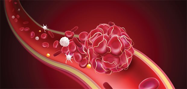 Wie sollte nach PCI auf lange Sicht antithrombotisch behandelt werden?
Thrombus im Gefäß