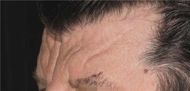 Atypische Stirnfalten: Wo kommen sie her? Aufnahme der Stirn des Mannes mit atypischen Stirnfalten.