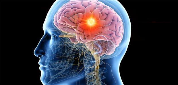 KI diagnostiziert Hirntumoren in zwölf Minuten statt zwölf Tagen Eine Darstellung des Gehirns mit einem Tumor.