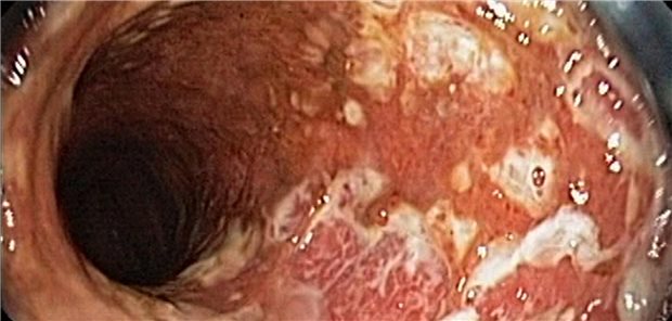 Das ist neu in der S3-Leitlinie Colitis ulcerosa Endoskopische Auffälligkeiten bei der Colitis ulcerosa
