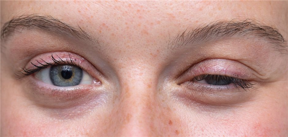 Myasthenia Gravis Eine Neuromuskuläre Übertragungsstörung