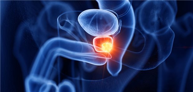 Prostatakrebs: Radioligandentherapie erstmals erfolgreich bei hormonsensitiven Tumoren geprüft 3D-Darstellung eines männlichen Unterleibs mit einem Tumor in der Prostata.