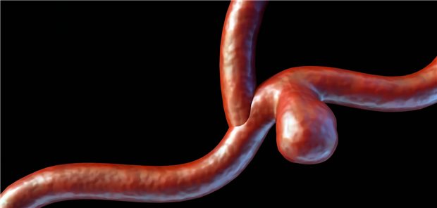 Viszerale Aneurysmen: Diese Risikogruppen kennen! 3d rendering of a saccular aneurysm, also known as a berry aneurysm, is a bulge that forms on the wall of a blood vessel in the brain