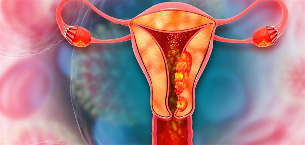 GLP-1-Rezeptoragonisten könnten Schutz vor Endometriumkarzinom verbessern Illustration eines Endometriumkarzinoms.
