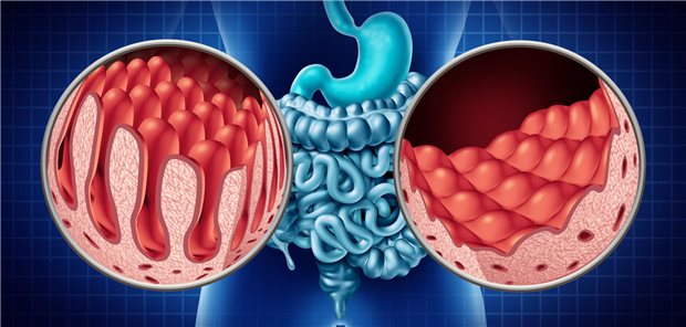 Alarmsymptome bei Zöliakie-Diagnose überwiegend folgenlos Dreidimensionale Darstellung des Einflusses von Zöliakie, einer Erkrankung der Darmanatomie, auf die Dünndarmschleimhaut im Vergleich zu gesunder mit Dünndarmschleimhaut mit gesunder Zottenbildung.