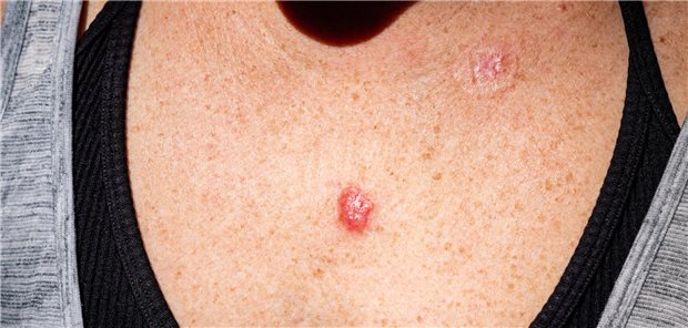 Weißer Hautkrebs entsteht bekanntlich, wenn die Haut regelmäßig einer hohen UV-Strahlung ausgesetzt ist. (Symbolbild)