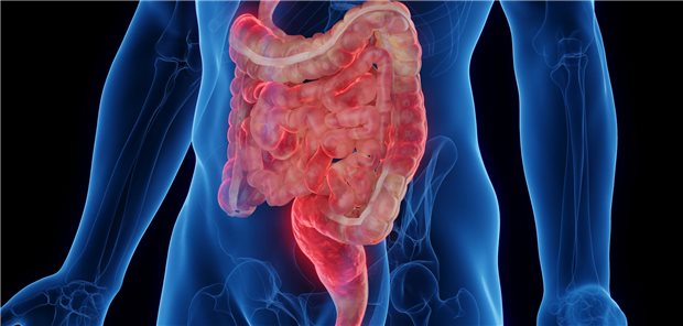 Morbus Crohn: Geschwister von früh Erkrankten haben selbst wohl ein besonders hohes Risiko Dreidimensionale gerenderte medizinische Illustration des Darms eines Mannes mit Morbus Crohn.