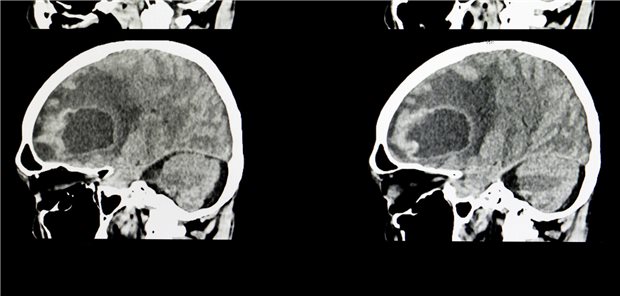 Schweres Schädelhirntrauma – erhöhtes Risiko für Hirntumoren CT-Scan des Gehirns eines Patienten mit einem großen metastasierten Tumor.