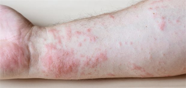 Dermatologische Komplikationen von „Chemsex“ Eine Dermatitis an einem Unterarm.