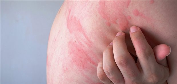 Die Spielregeln für die Verordnung von Antihistaminika und Kortikoid-Spray Rote Kratzspuren auf der Haut wegen einer Urtikaria.