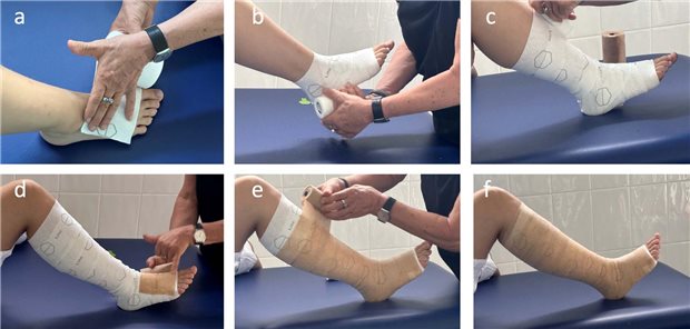 Ulcus cruris venosum: Was für die Kompressionstherapie wichtig ist Zwei-Lagen-Verband